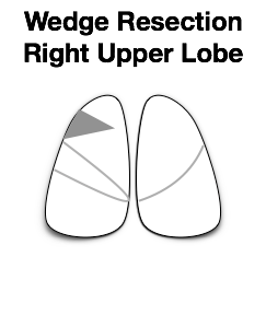 Lung1